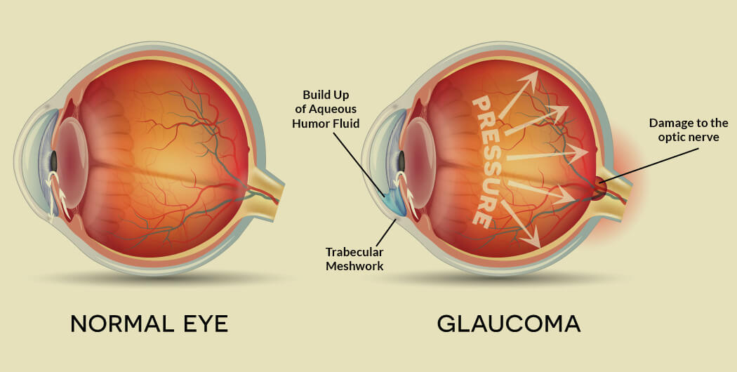 Можно вернуть зрение при глаукоме